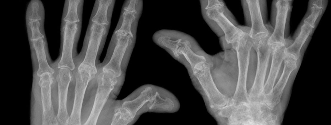 Rheumatoid arthritis Even patients with severely bent fingers can receive optimal treatment with a FingerKIt implant